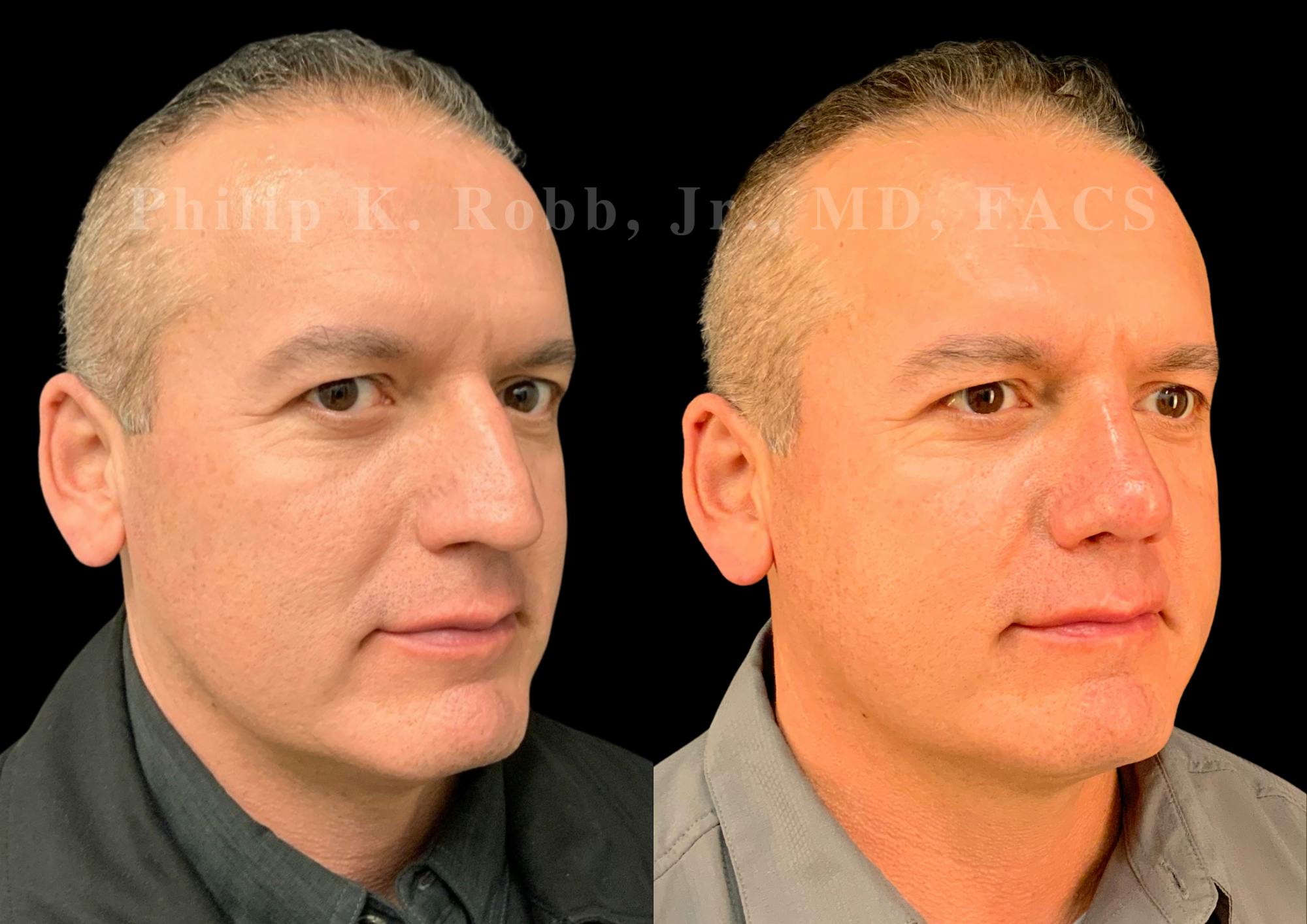 Ultrasonic Rhinoplasty Before & After Gallery - Patient 532770 - Image 2