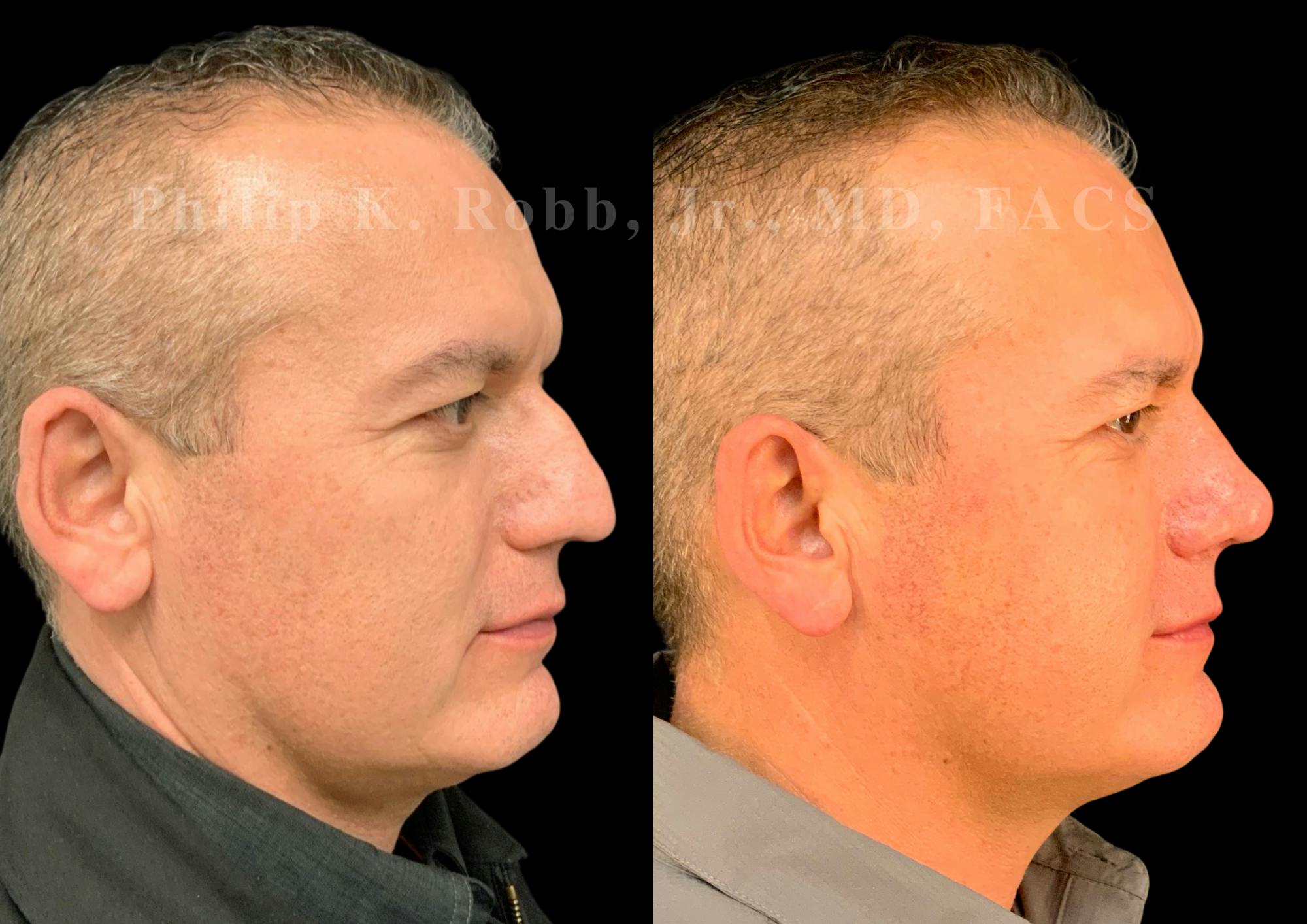 Ultrasonic Rhinoplasty Before & After Gallery - Patient 532770 - Image 1