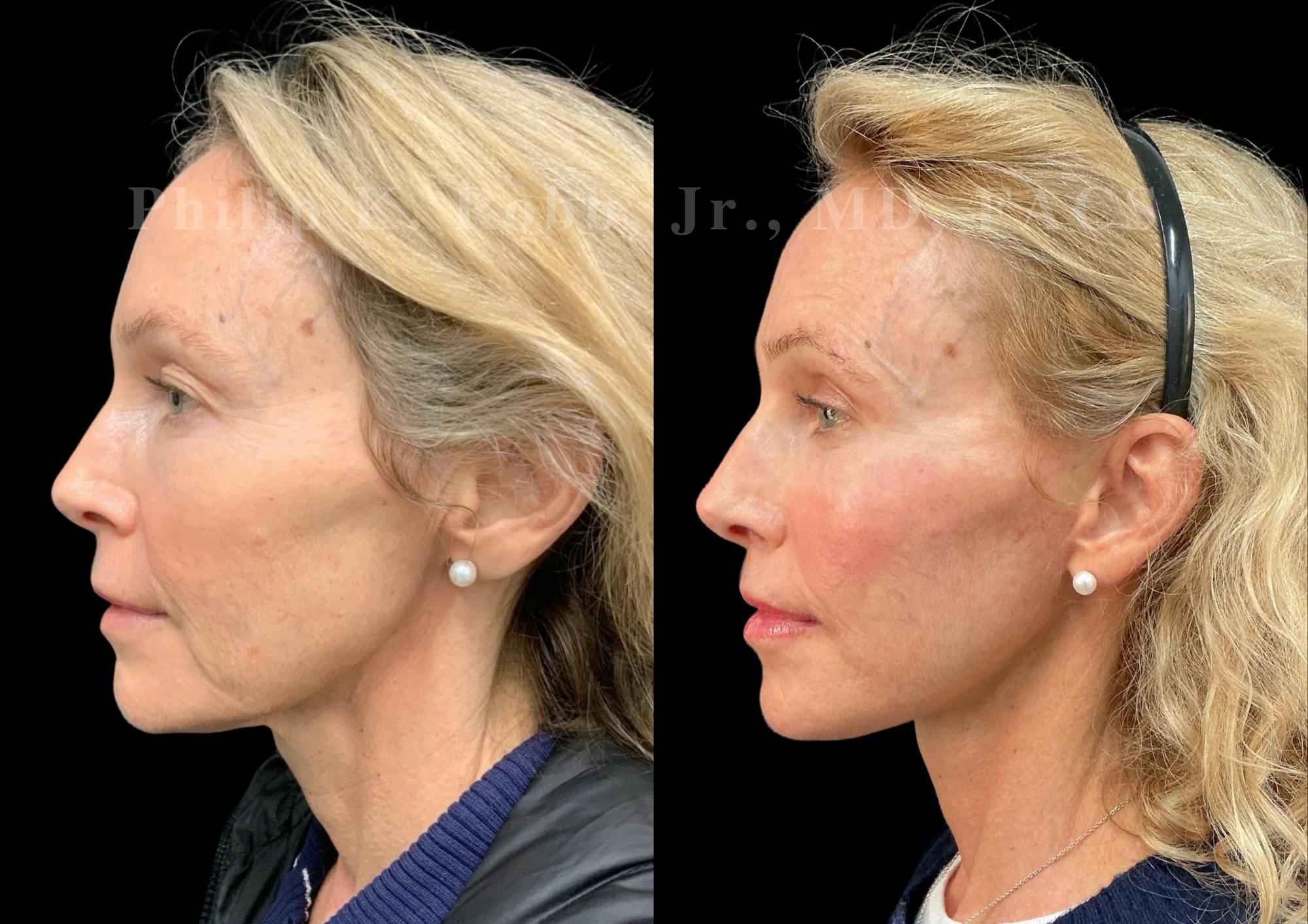 Neck Lift Before & After Gallery - Patient 211582 - Image 1
