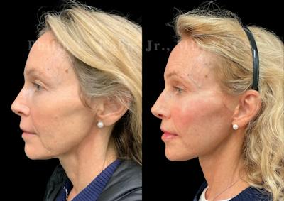Neck Lift Before & After Gallery - Patient 211582 - Image 1