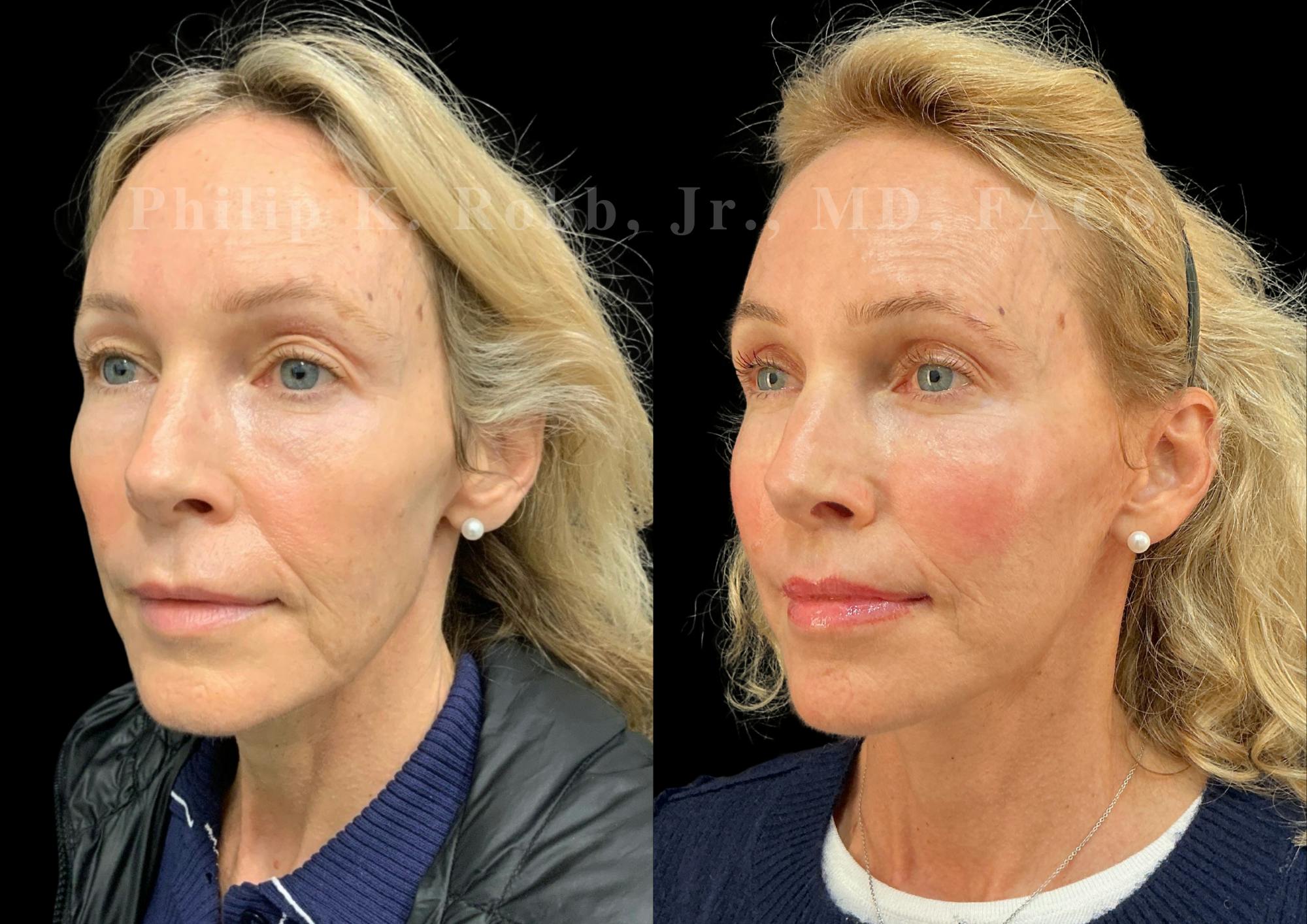 Neck Lift Before & After Gallery - Patient 211582 - Image 3