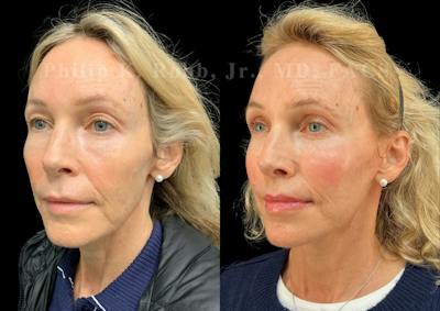 Facelift Before & After Gallery - Patient 281890 - Image 1