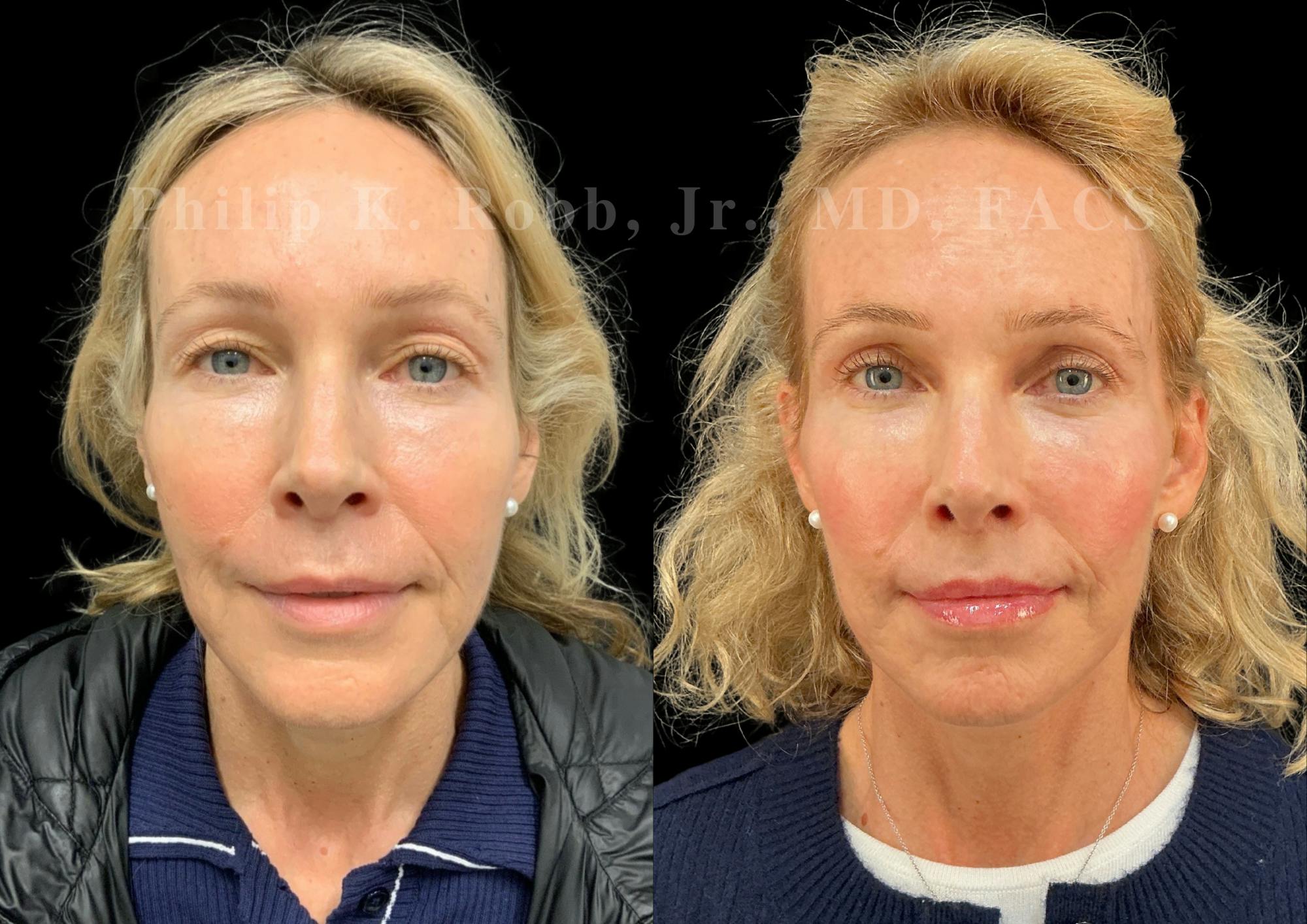 Neck Lift Before & After Gallery - Patient 211582 - Image 4