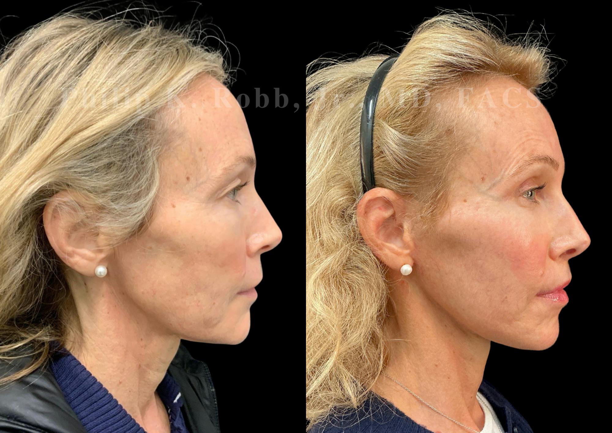 Neck Lift Before & After Gallery - Patient 211582 - Image 6