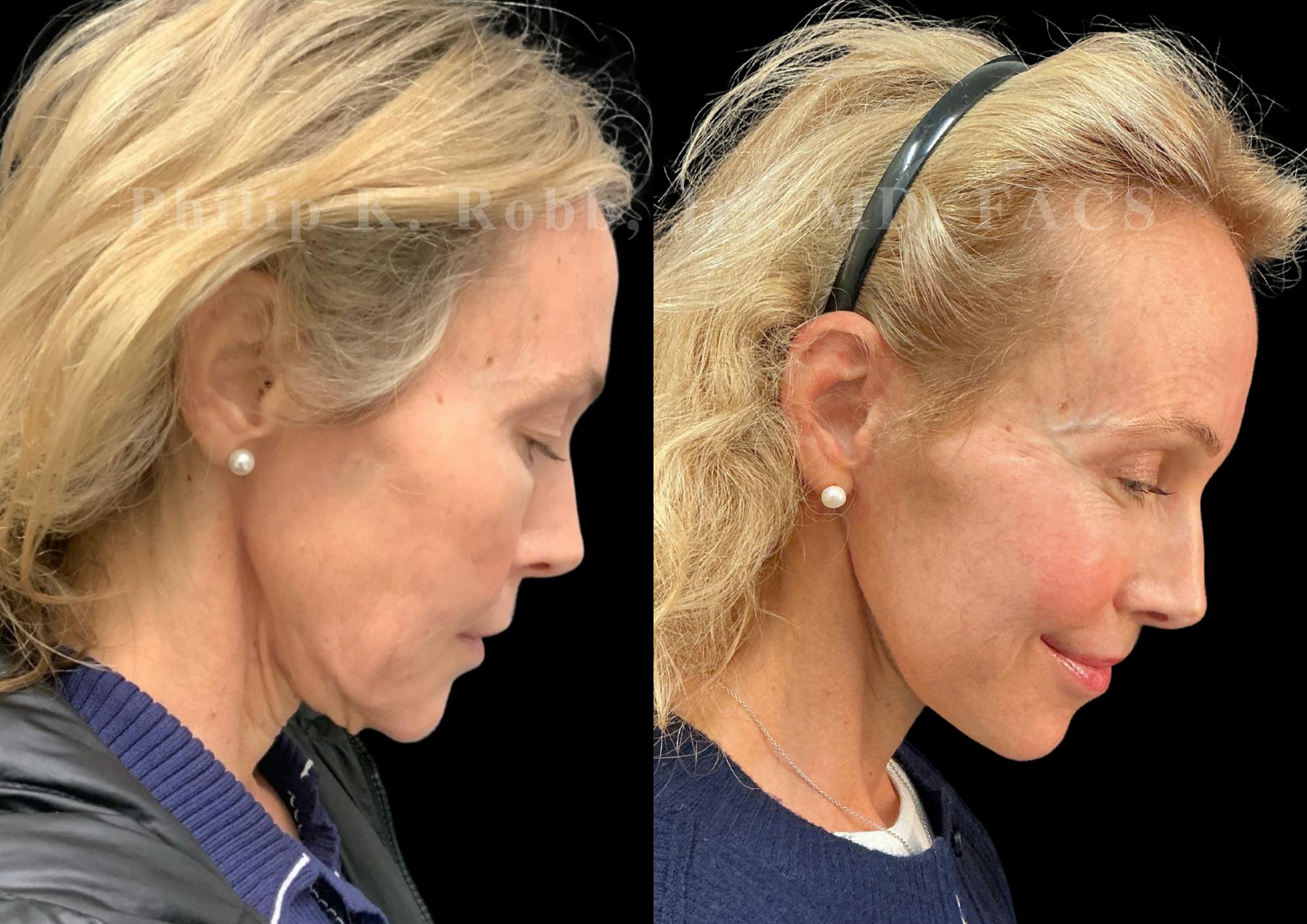 Neck Lift Before & After Gallery - Patient 211582 - Image 7