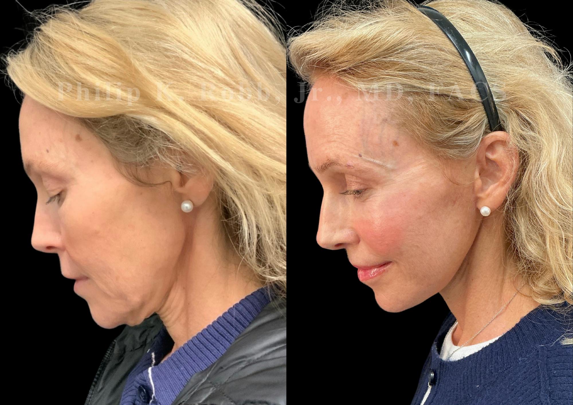 Neck Lift Before & After Gallery - Patient 211582 - Image 2