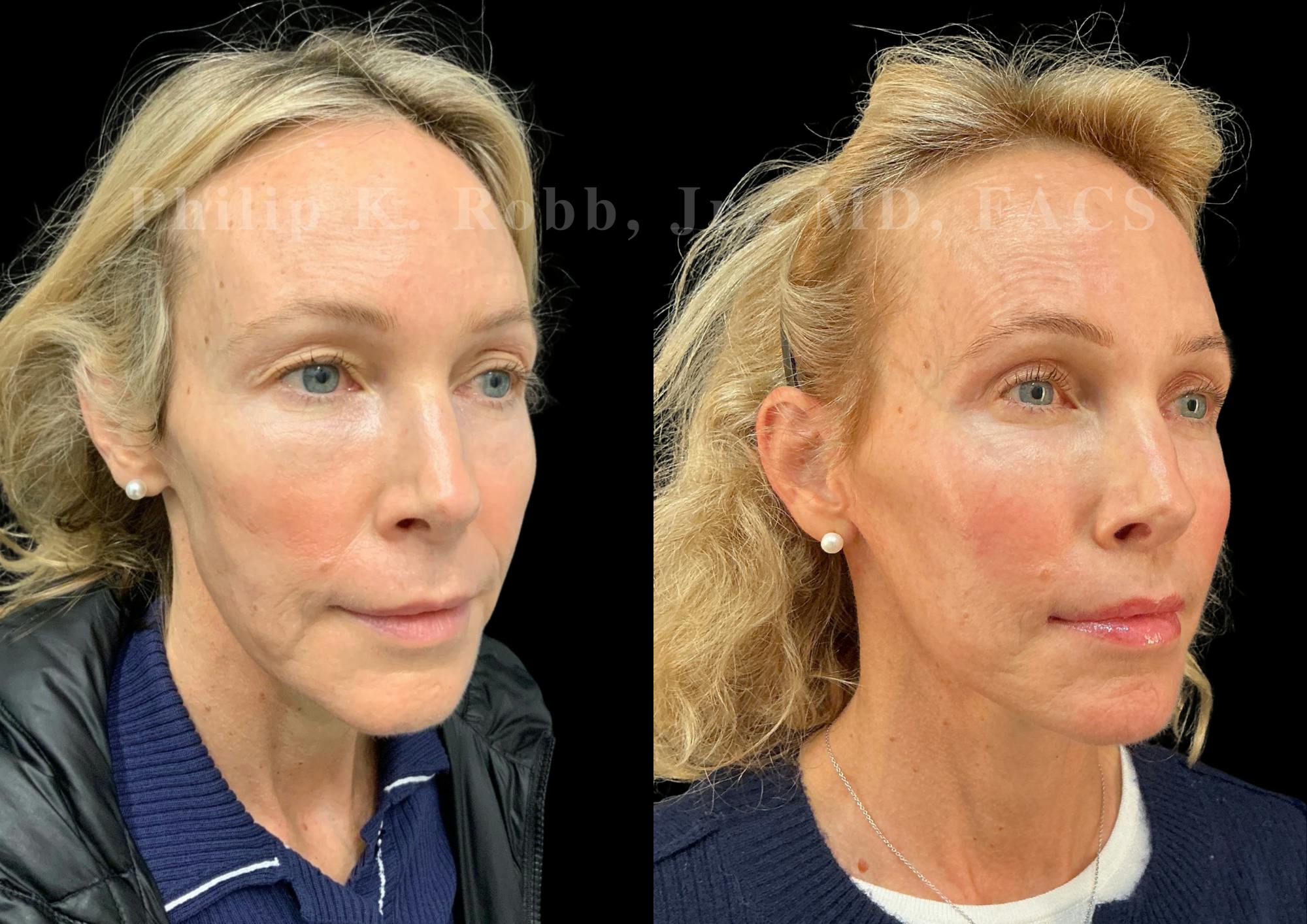 Neck Lift Before & After Gallery - Patient 211582 - Image 5