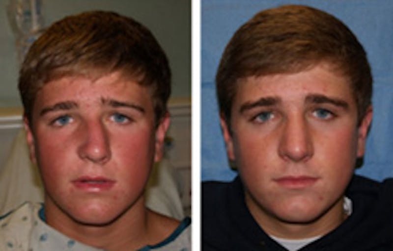Rhinoplasty before & after
