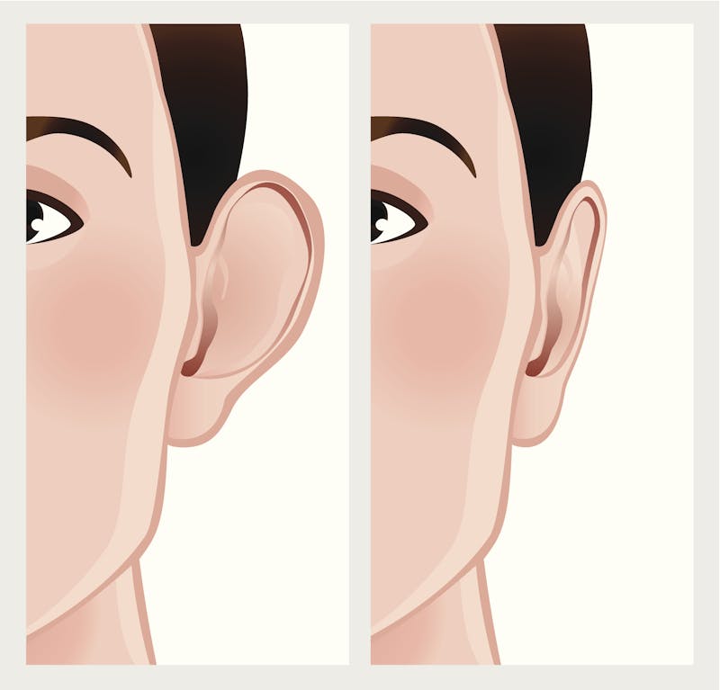 Otoplasty Before & After Graphic