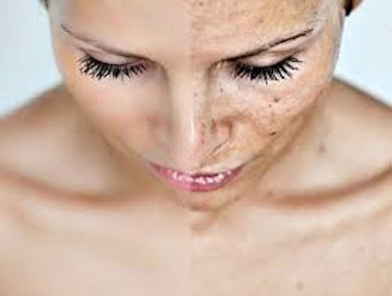 Melasma before & after comparison