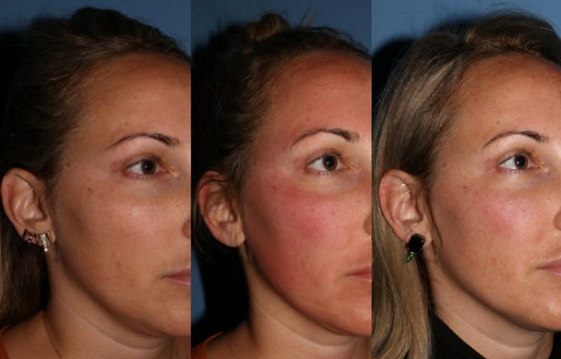 laser treatment before and after comparison