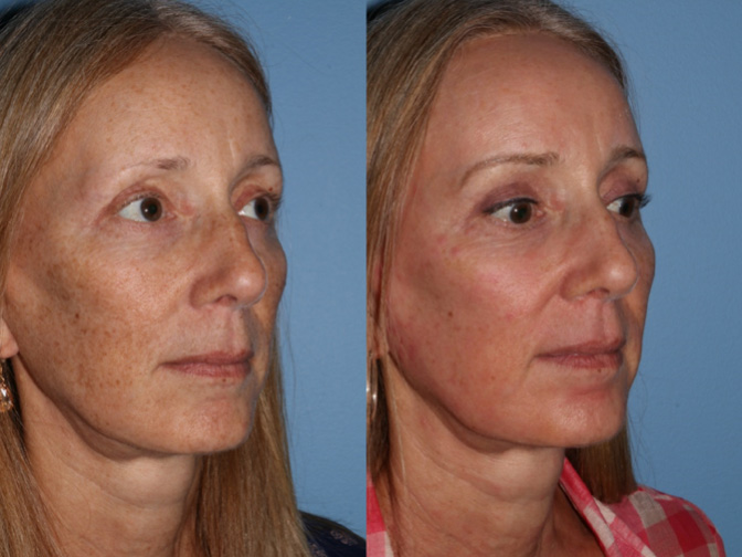 Before and one week after Acupulse CO2 laser treatment
