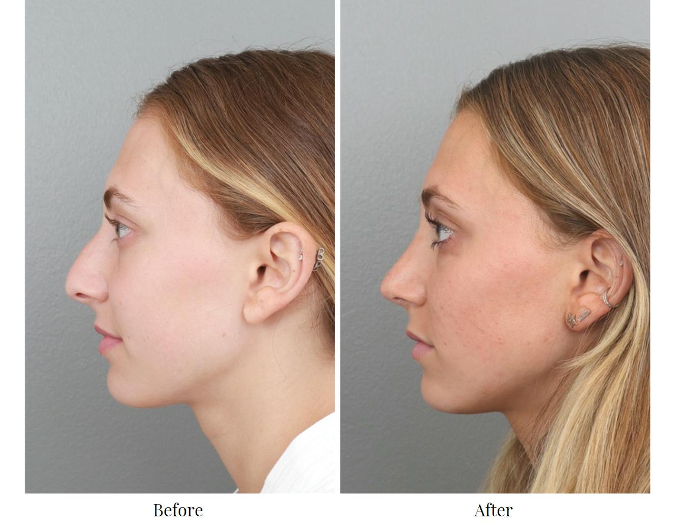 Rhinoplasty Before & After Gallery - Patient 64080943 - Image 4