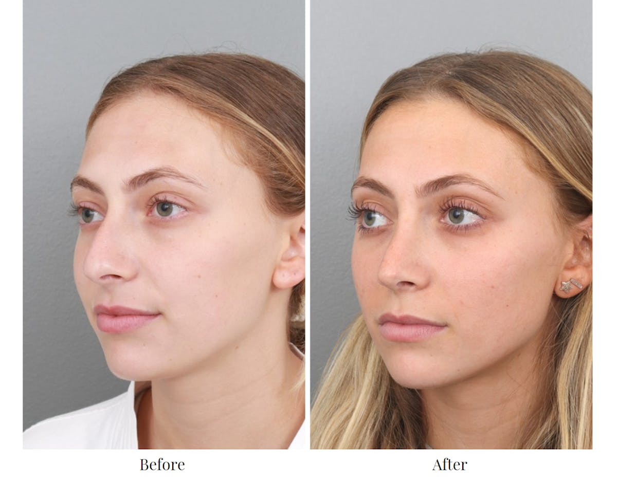 Rhinoplasty Before & After Gallery - Patient 64080943 - Image 3
