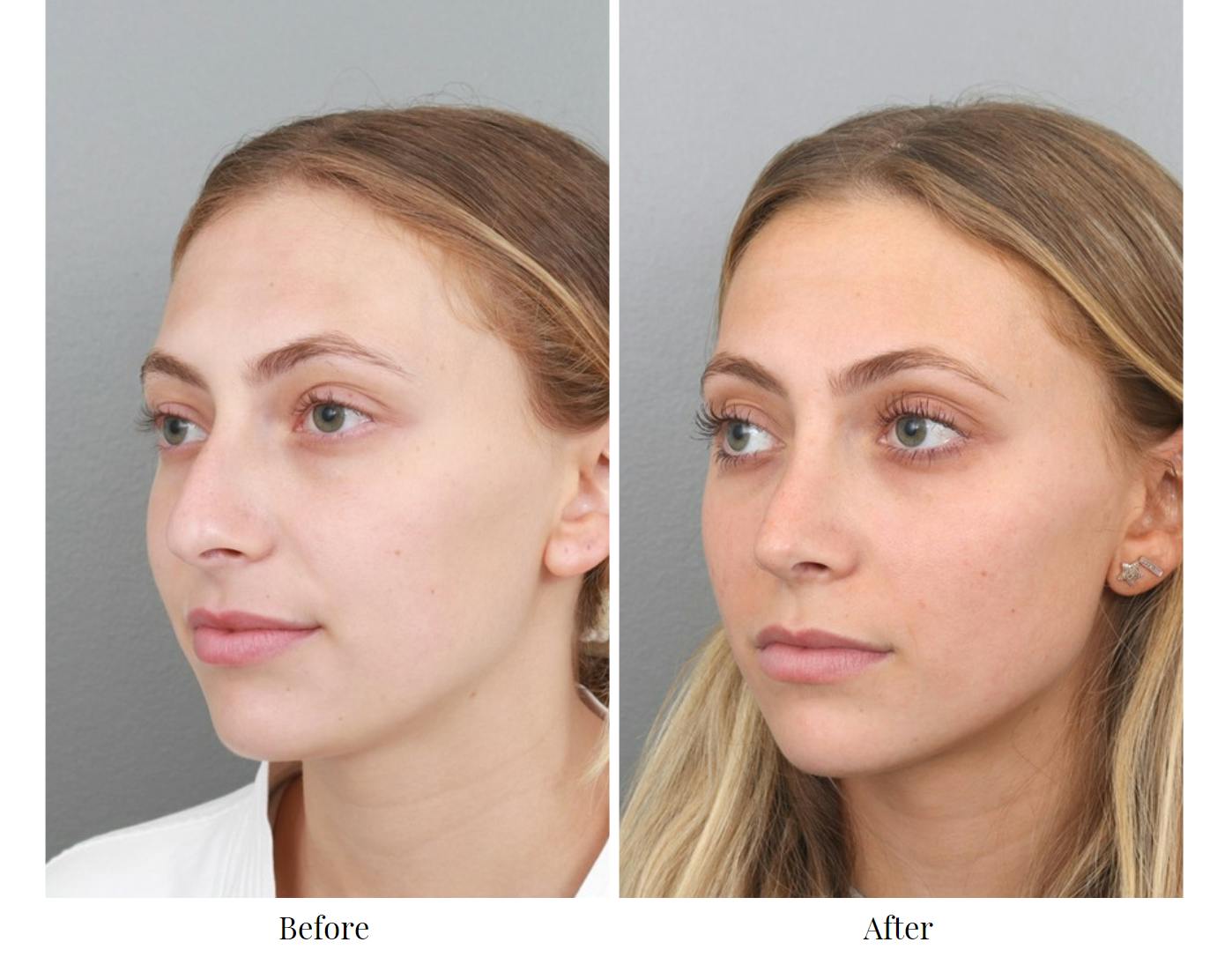 Rhinoplasty Before & After Gallery - Patient 64080943 - Image 3