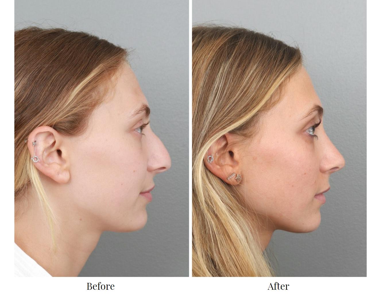 Rhinoplasty Before & After Gallery - Patient 64080943 - Image 5