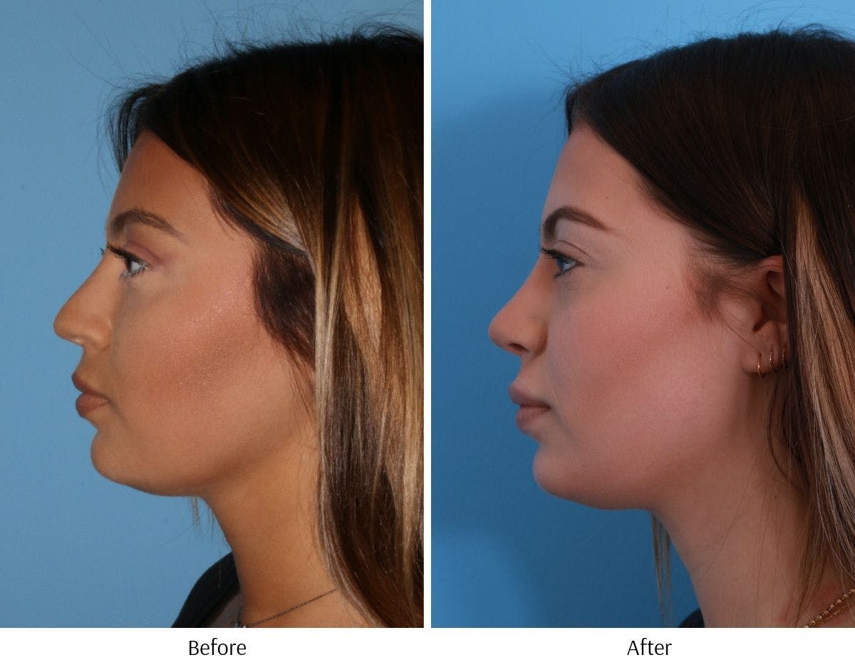 Rhinoplasty Before & After Gallery - Patient 64080944 - Image 4