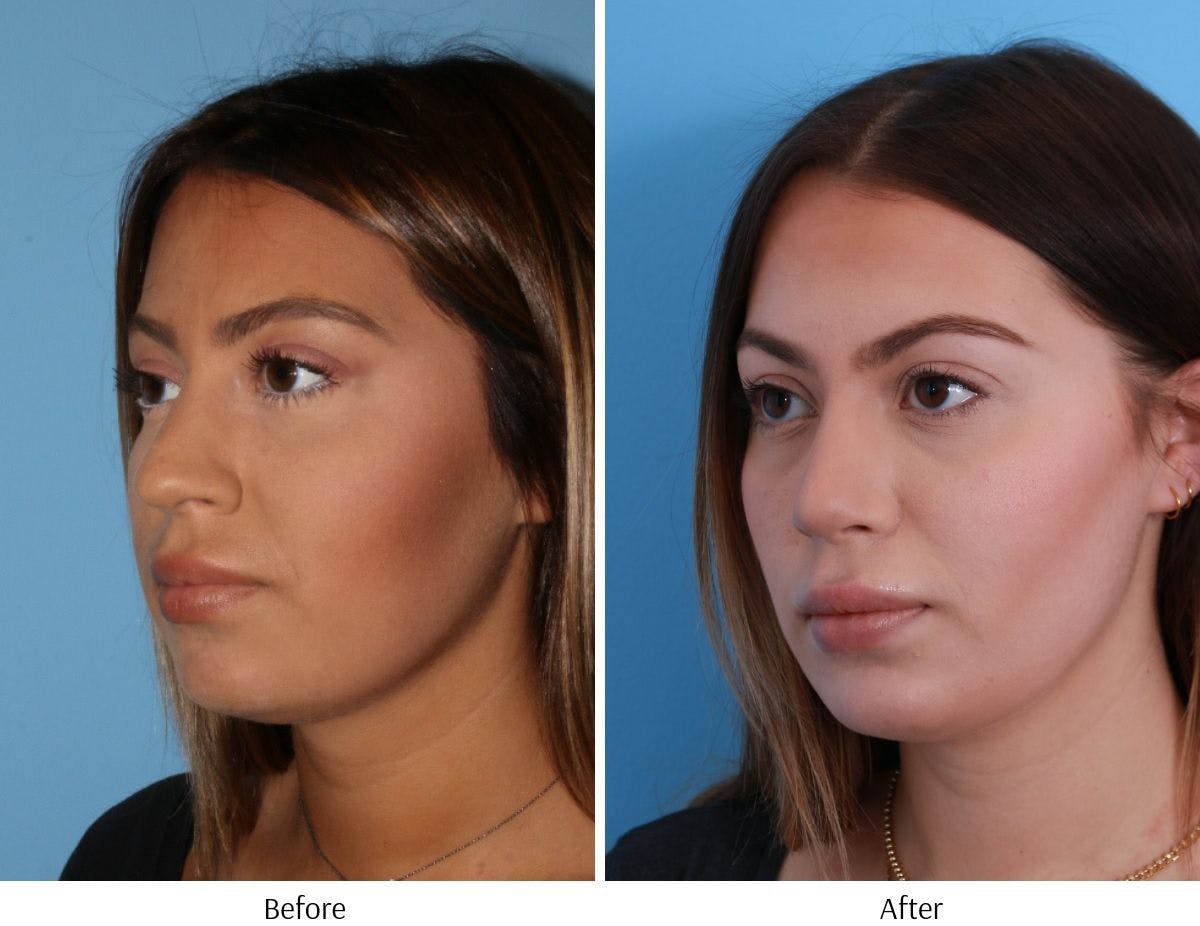 Rhinoplasty Before & After Gallery - Patient 64080944 - Image 4