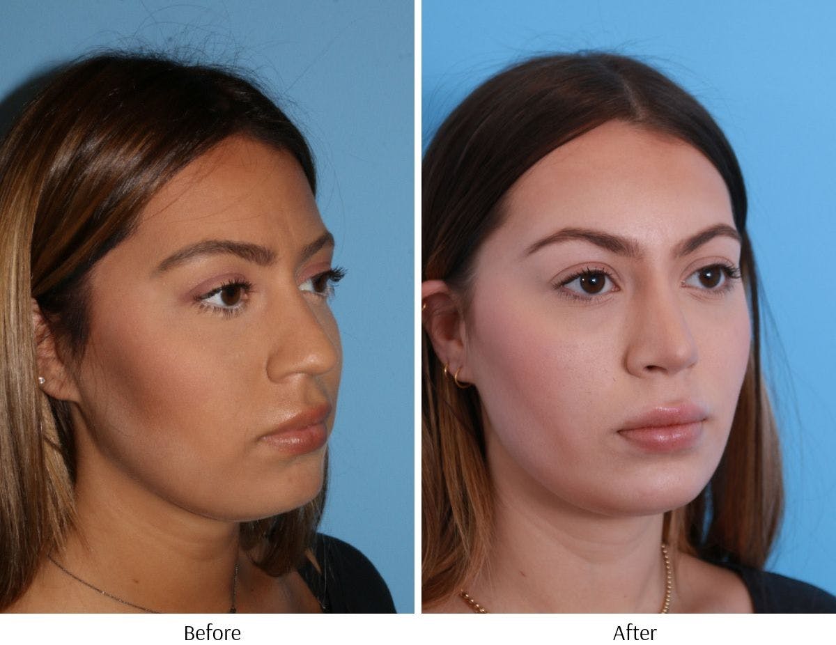 Rhinoplasty Before & After Gallery - Patient 64080944 - Image 5