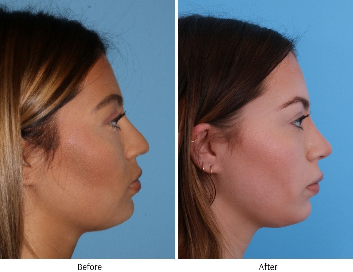 Rhinoplasty Before & After Gallery - Patient 64080944 - Image 3