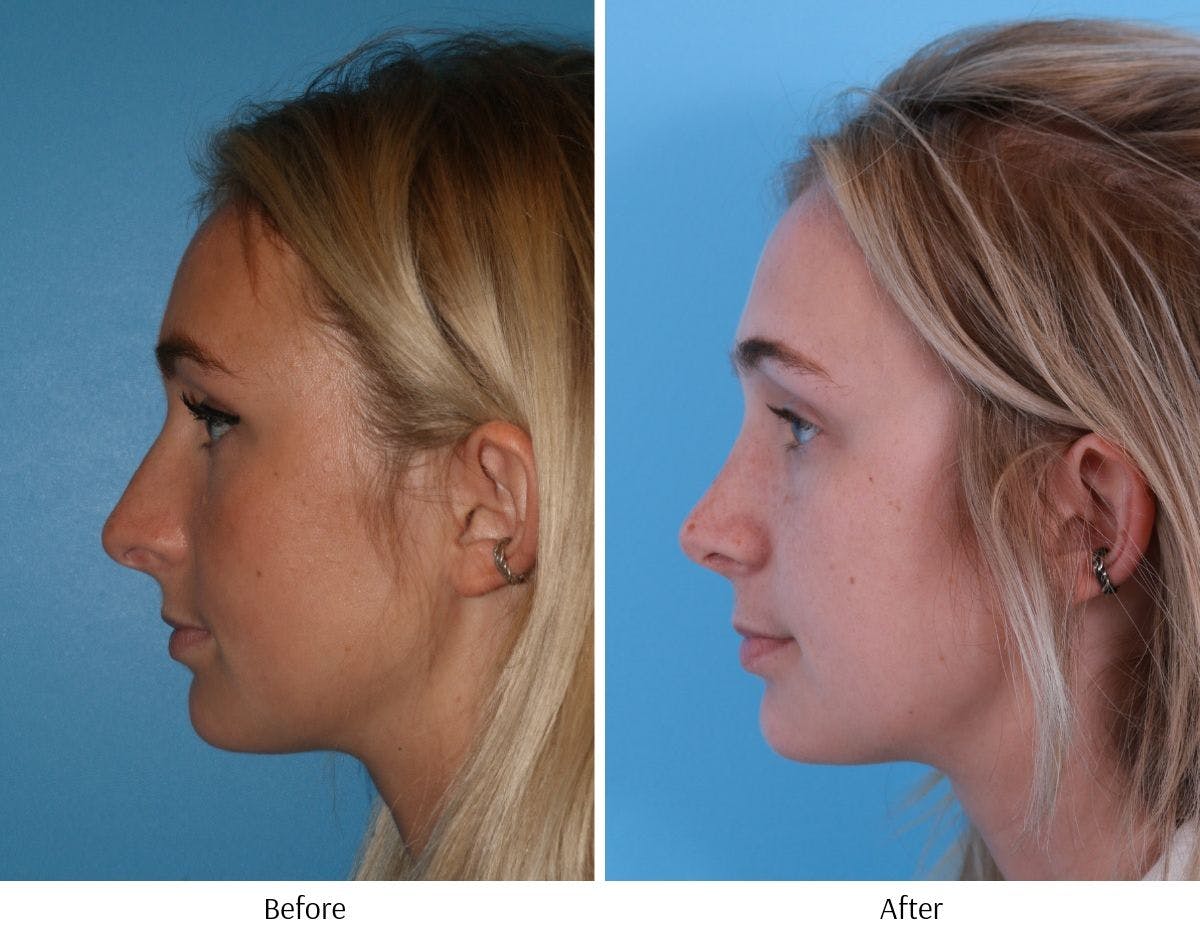Rhinoplasty Before & After Gallery - Patient 64080945 - Image 2
