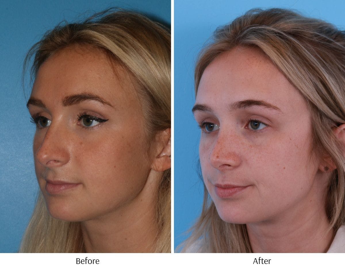 Rhinoplasty Before & After Gallery - Patient 64080945 - Image 3