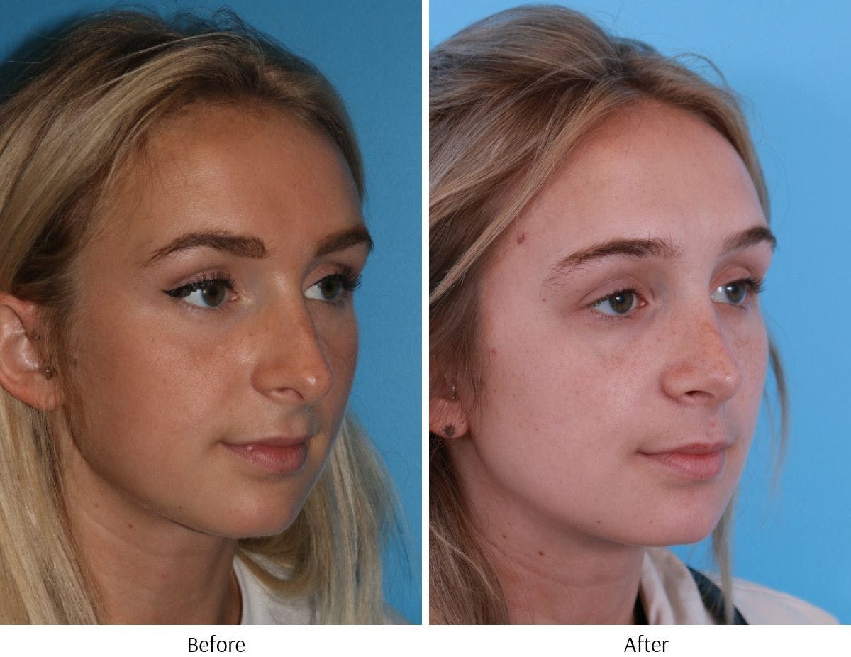 Rhinoplasty Before & After Gallery - Patient 64080945 - Image 4