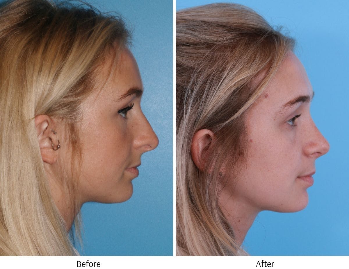 Rhinoplasty Before & After Gallery - Patient 64080945 - Image 5