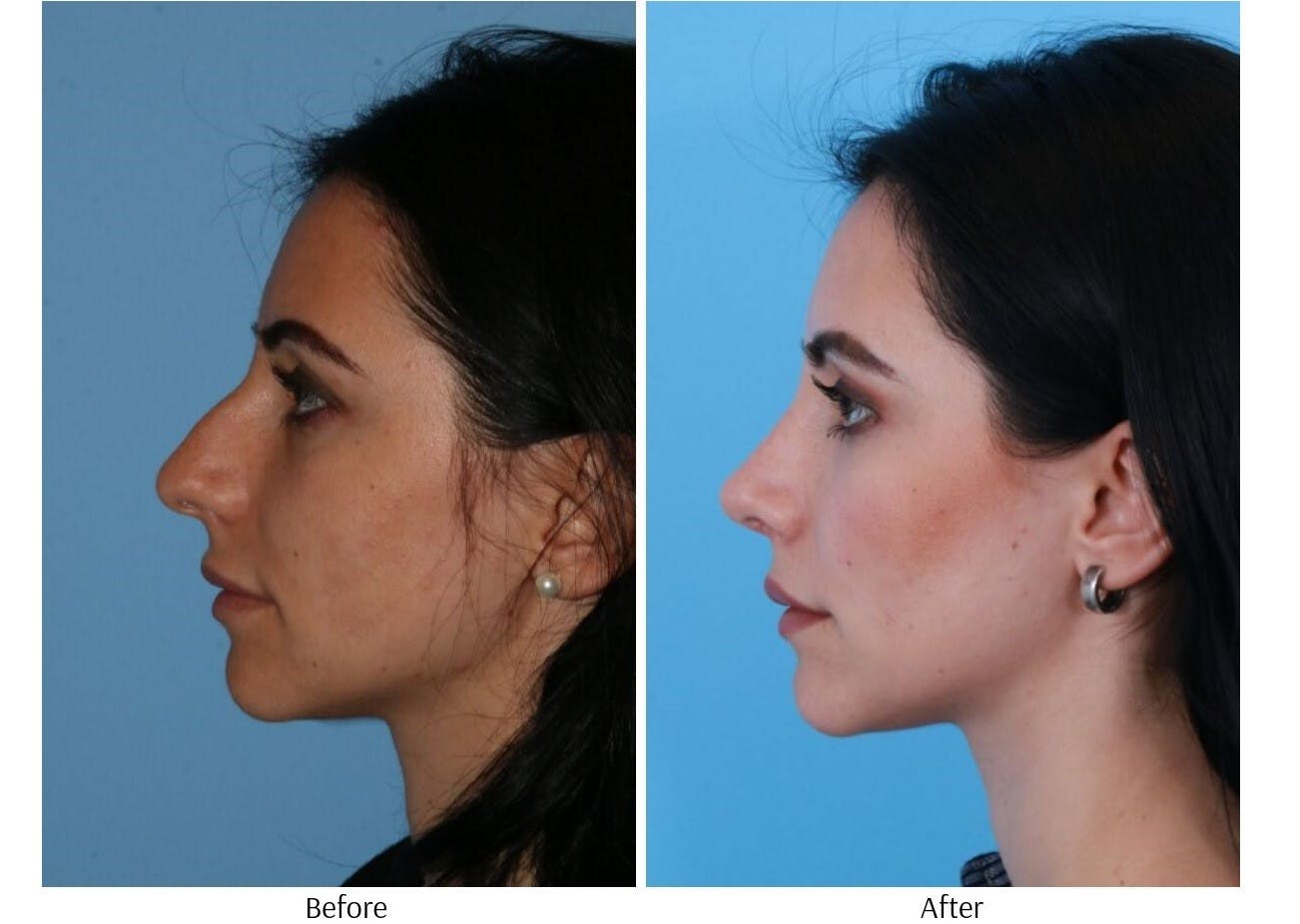 Rhinoplasty Before & After Gallery - Patient 64080946 - Image 3