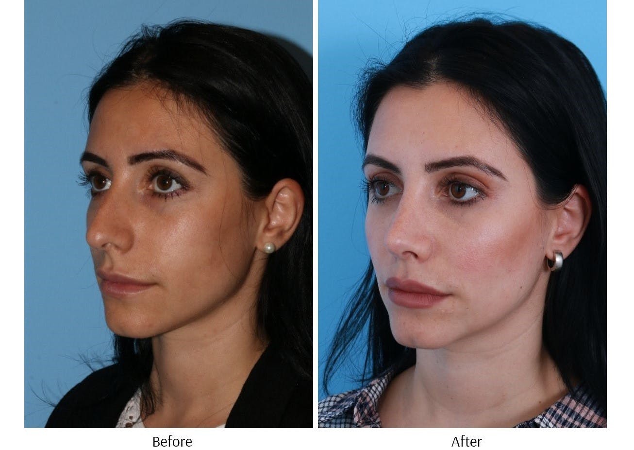 Rhinoplasty Before & After Gallery - Patient 64080946 - Image 4