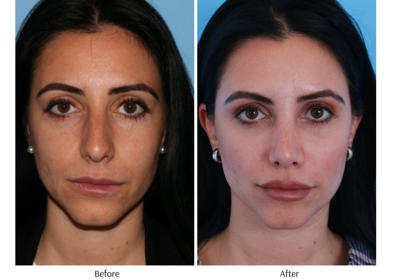 Rhinoplasty Before & After Gallery - Patient 64080946 - Image 5