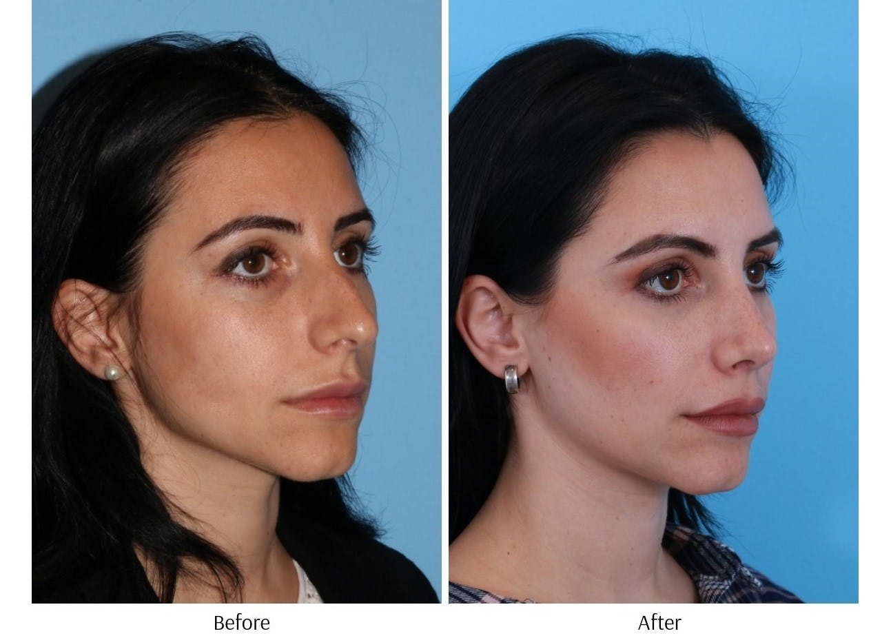 Rhinoplasty Before & After Gallery - Patient 64080946 - Image 2