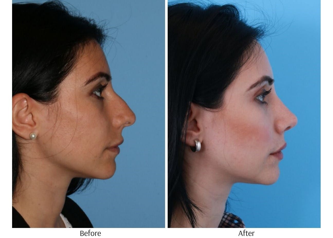 Rhinoplasty Before & After Gallery - Patient 64080946 - Image 3