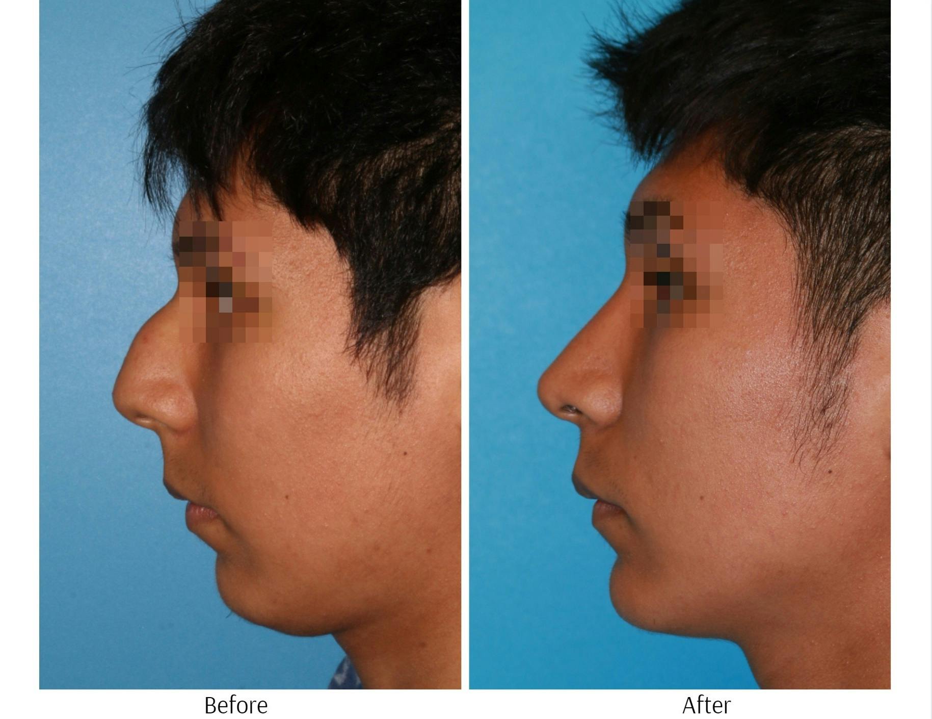Rhinoplasty Before & After Gallery - Patient 64080947 - Image 2