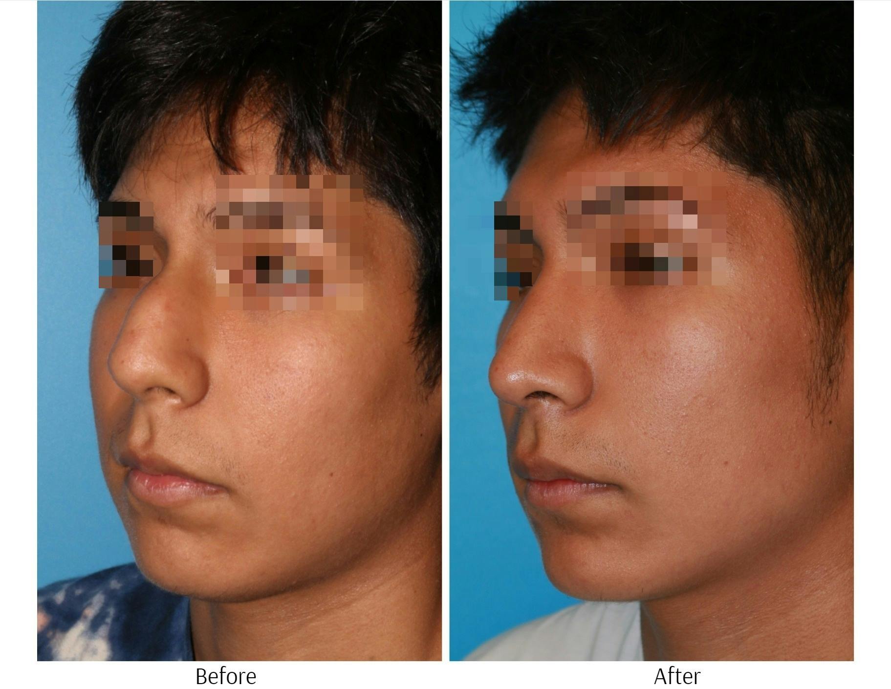Rhinoplasty Before & After Gallery - Patient 64080947 - Image 3