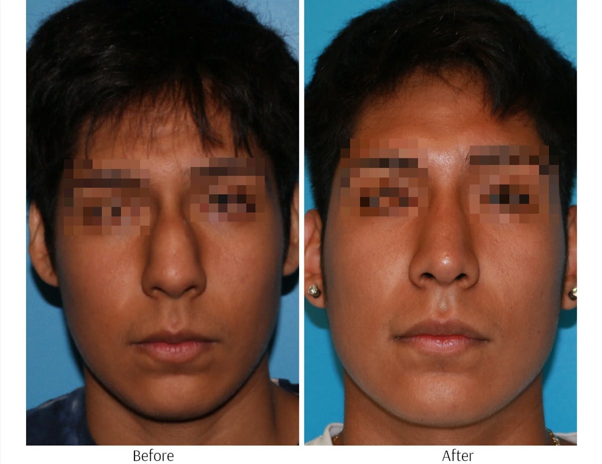 Rhinoplasty Before & After Gallery - Patient 64080947 - Image 4