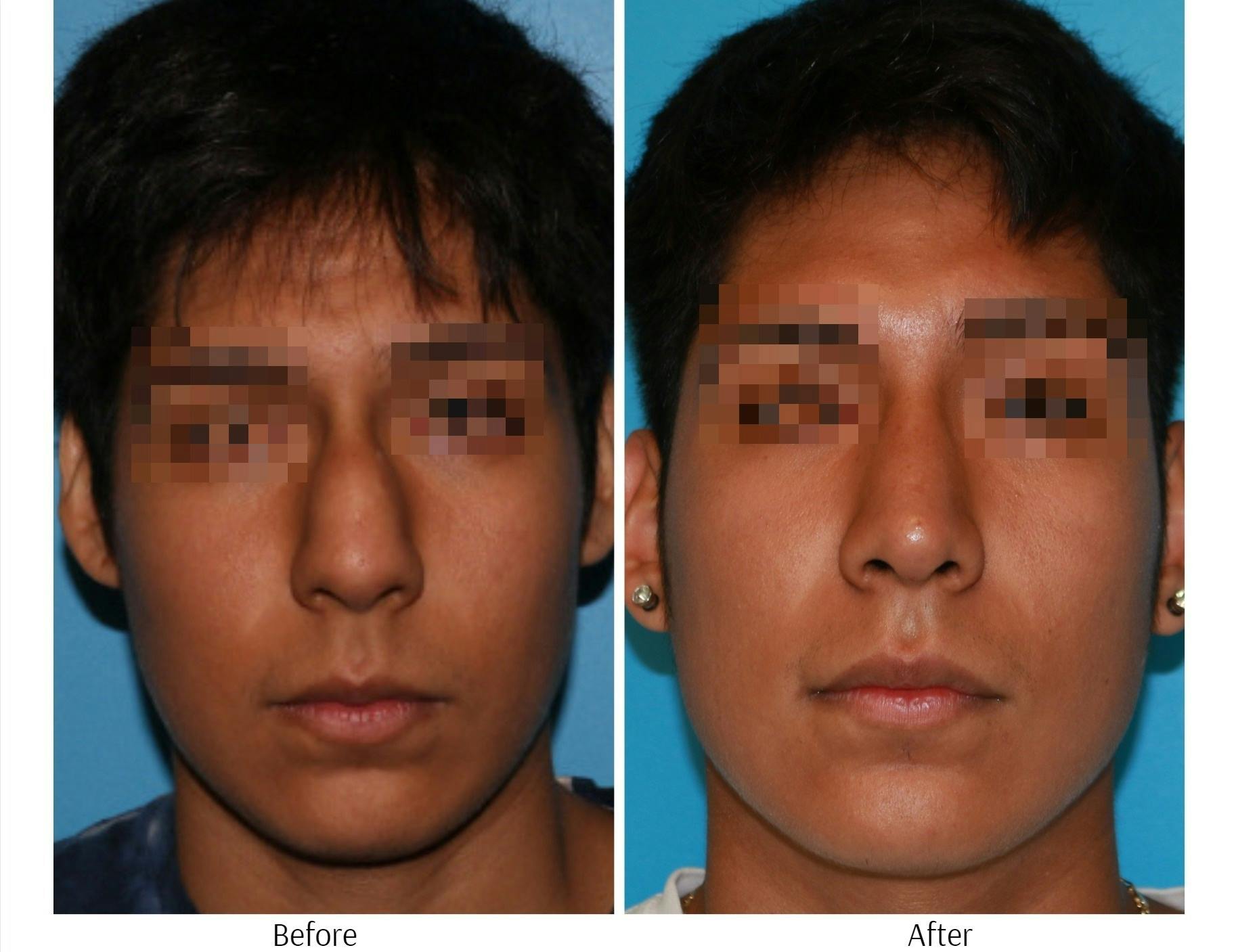 Rhinoplasty Before & After Gallery - Patient 64080947 - Image 4