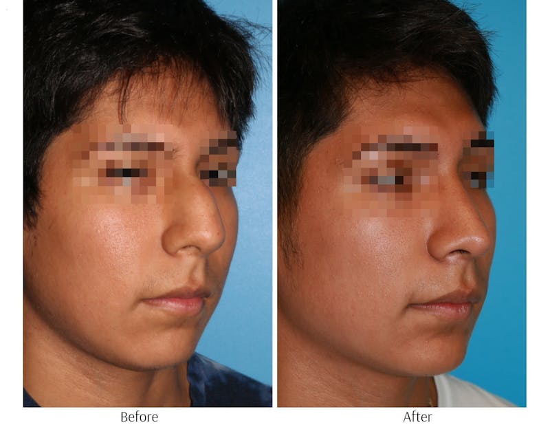 Rhinoplasty Before & After Gallery - Patient 64080947 - Image 1