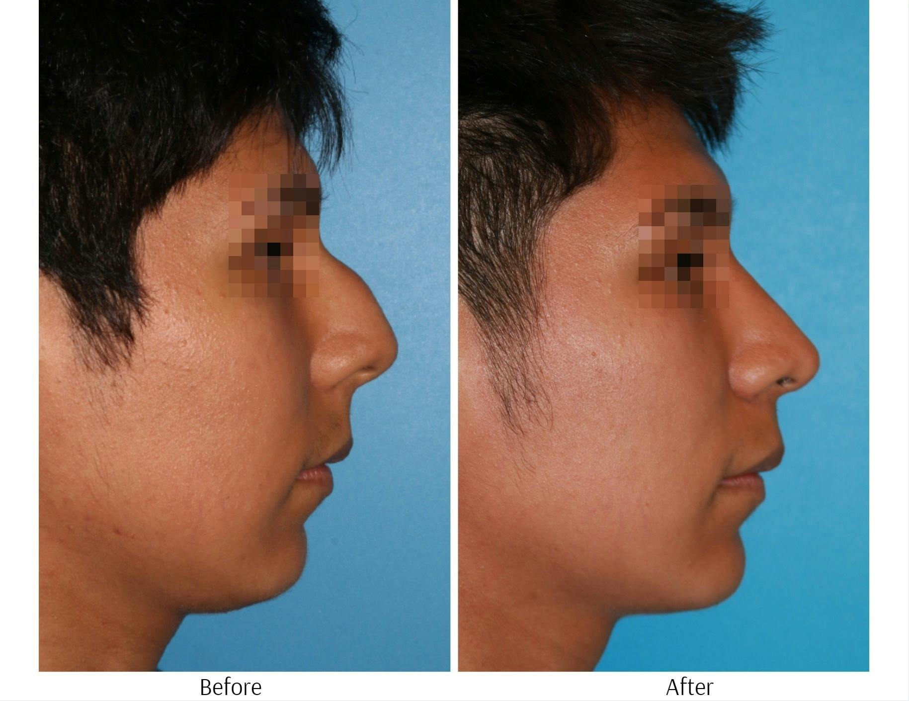 Rhinoplasty Before & After Gallery - Patient 64080947 - Image 5