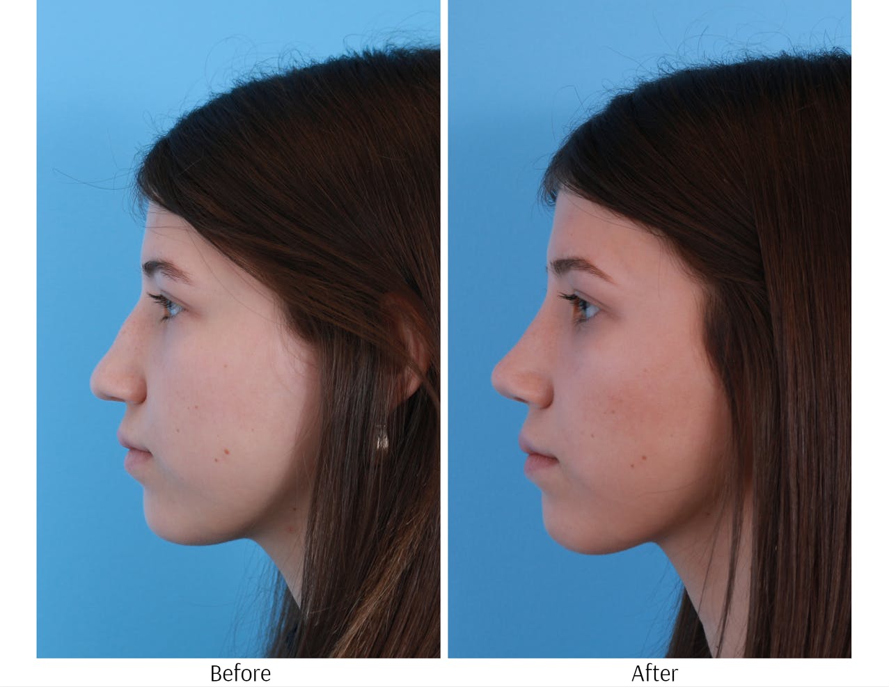Rhinoplasty Before & After Gallery - Patient 64080948 - Image 2