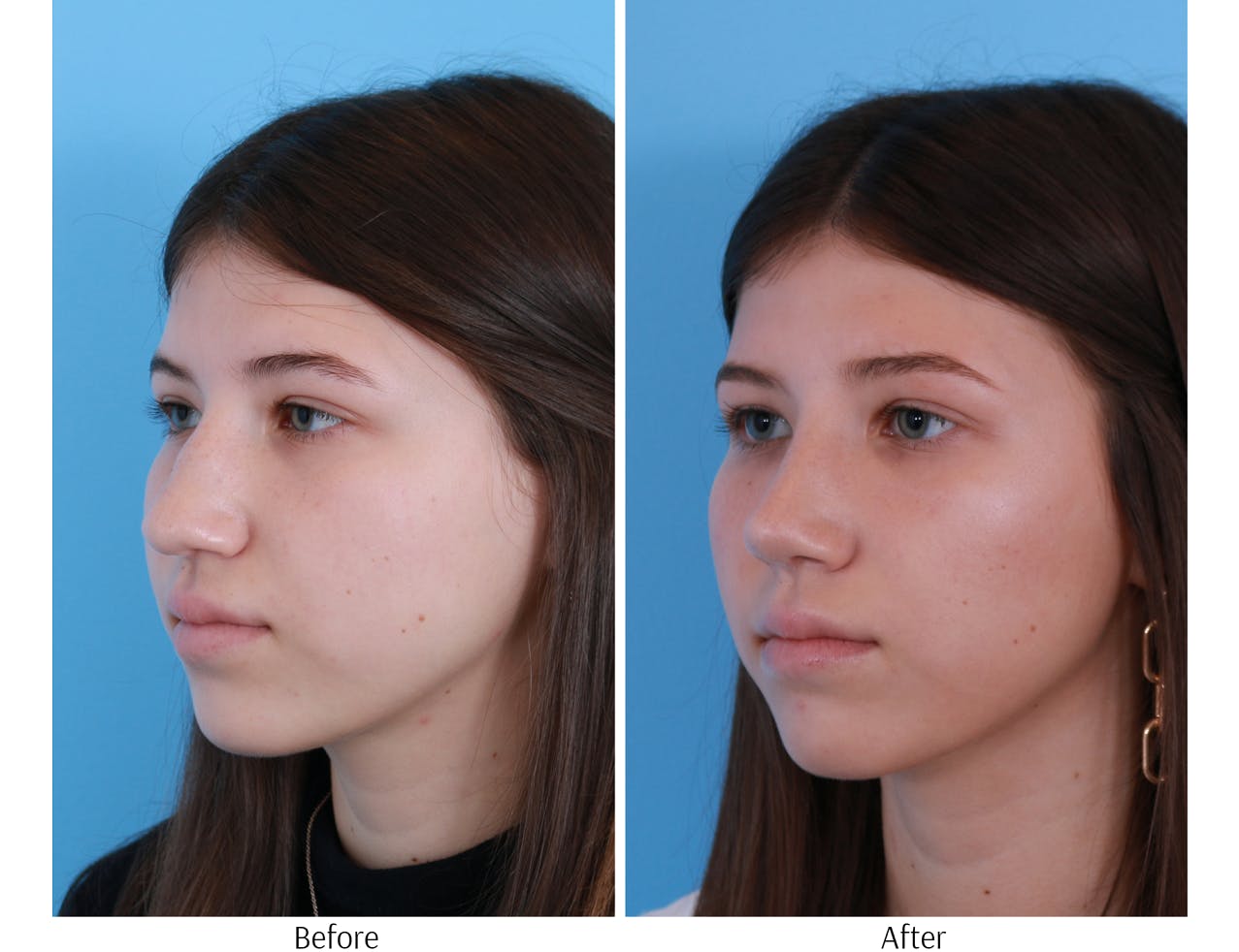 Rhinoplasty Before & After Gallery - Patient 64080948 - Image 3