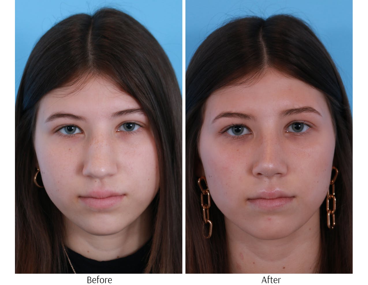 Rhinoplasty Before & After Gallery - Patient 64080948 - Image 1