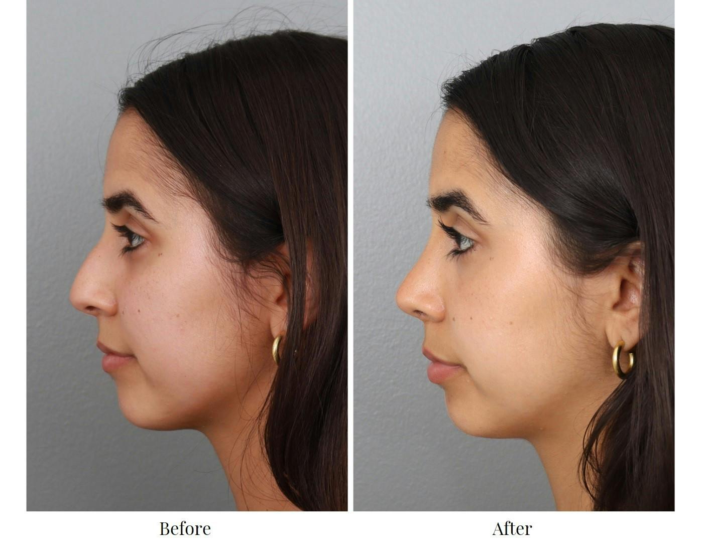 Rhinoplasty Before & After Gallery - Patient 64080949 - Image 2