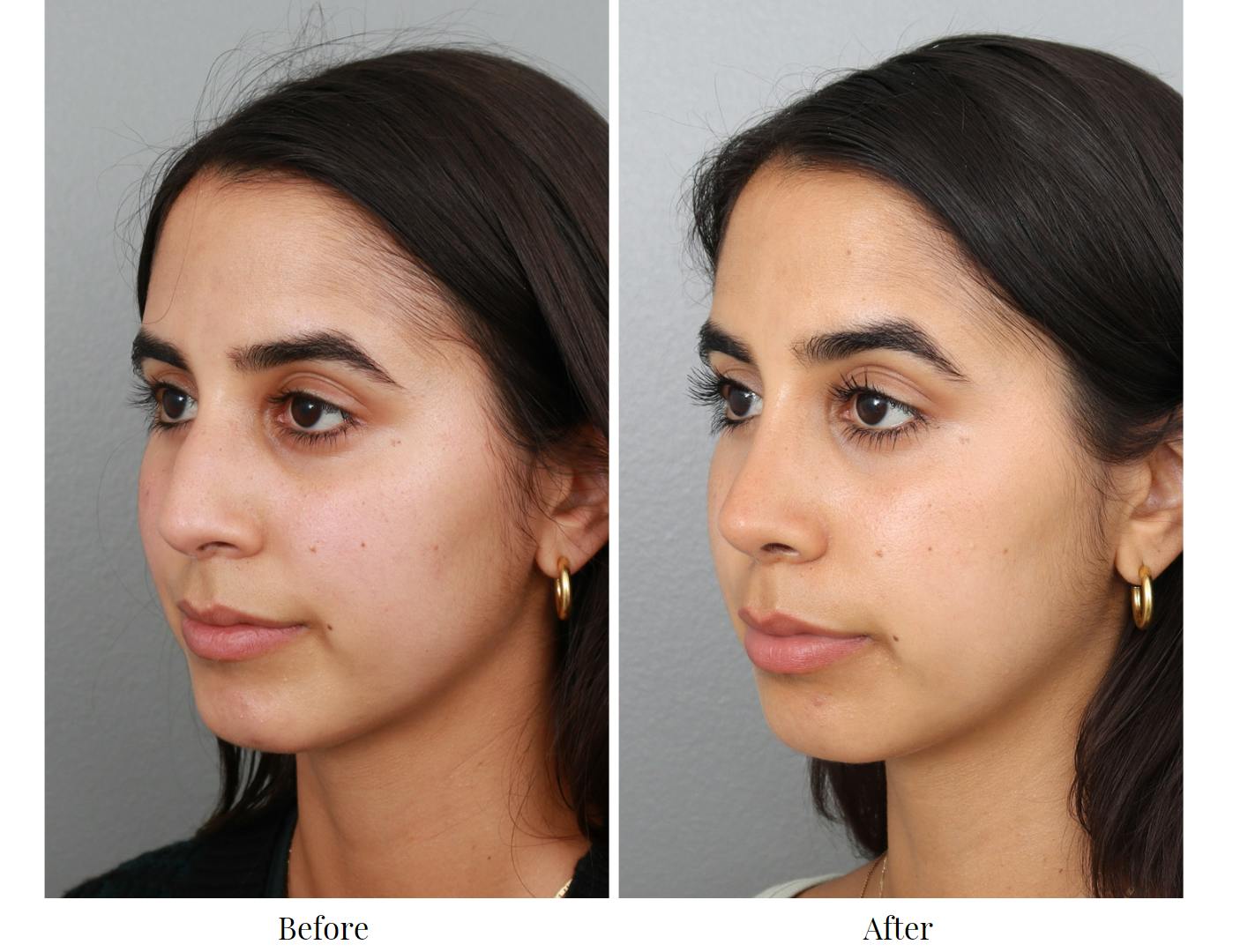 Rhinoplasty Before & After Gallery - Patient 64080949 - Image 3