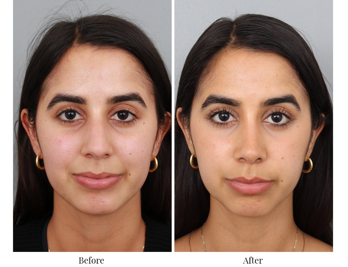 Rhinoplasty Before & After Gallery - Patient 64080949 - Image 4