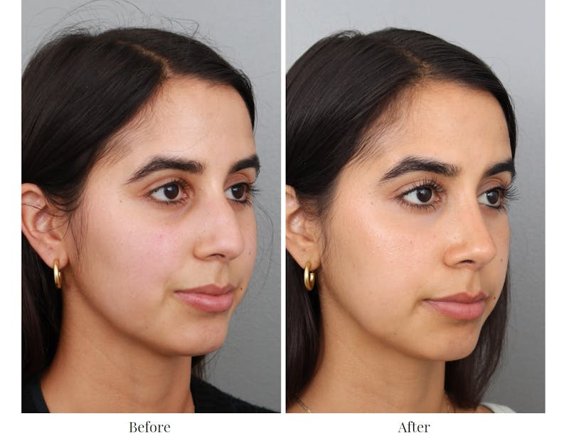 Rhinoplasty Before & After Gallery - Patient 64080949 - Image 1