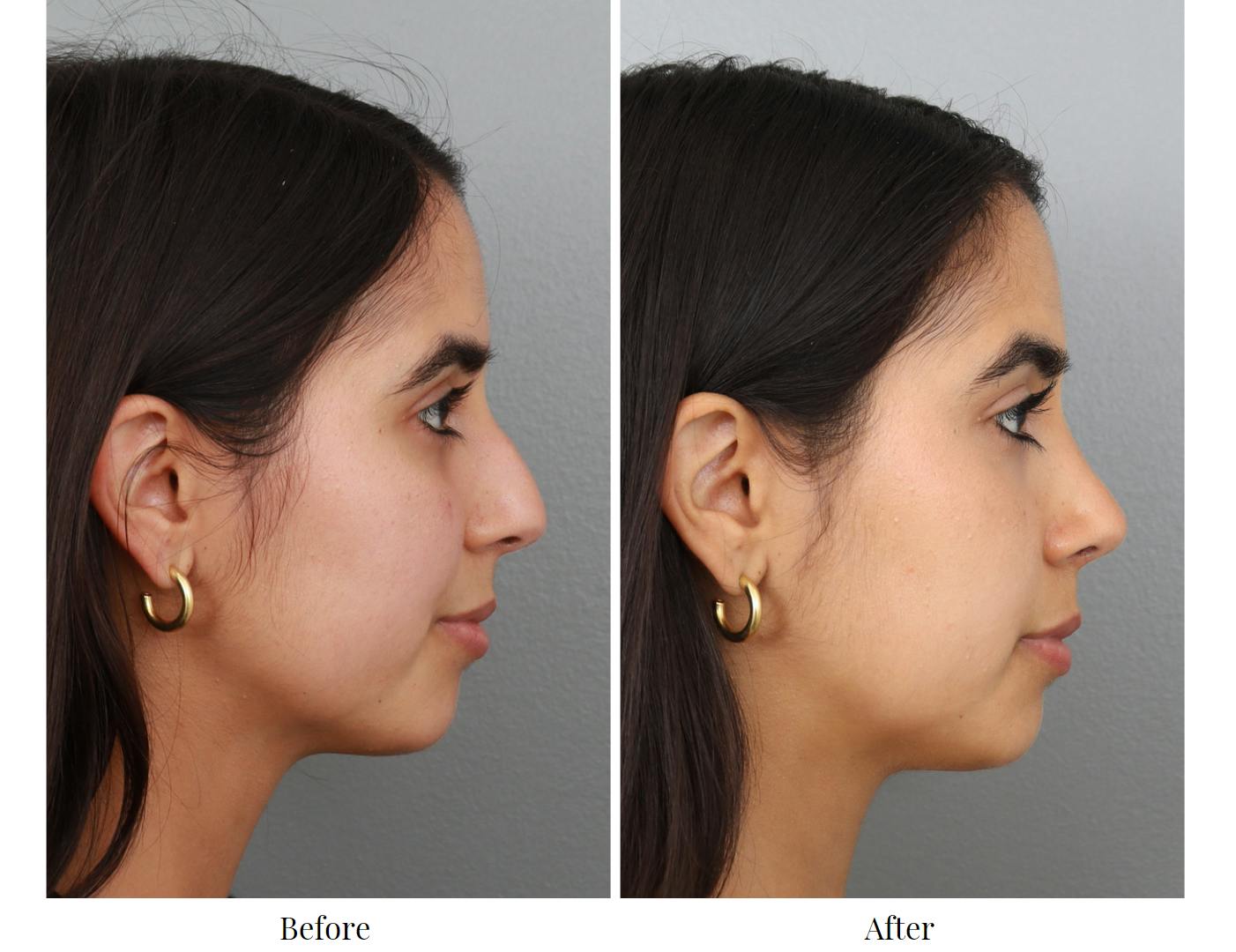 Rhinoplasty Before & After Gallery - Patient 64080949 - Image 5
