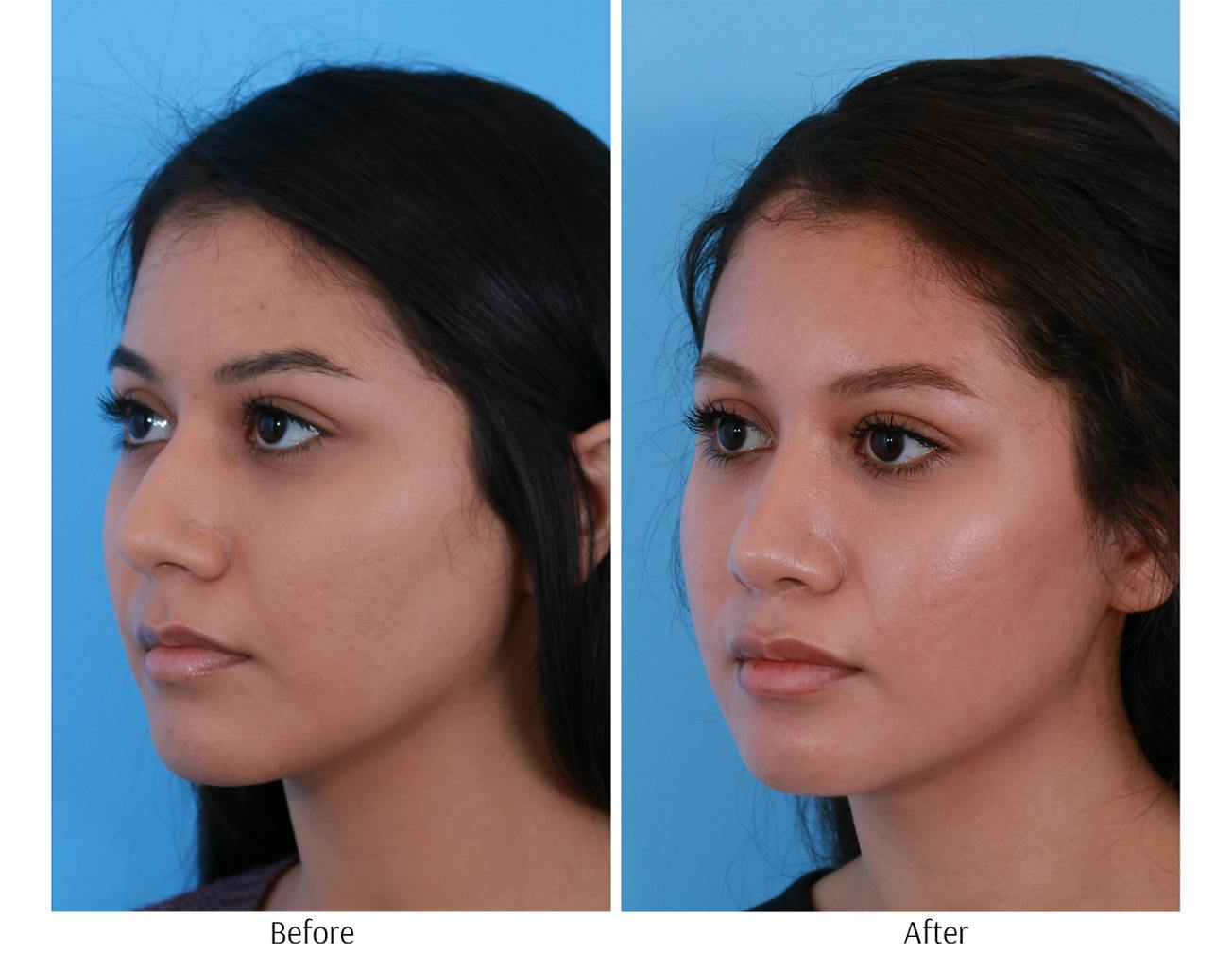 Rhinoplasty Before & After Gallery - Patient 64080950 - Image 3