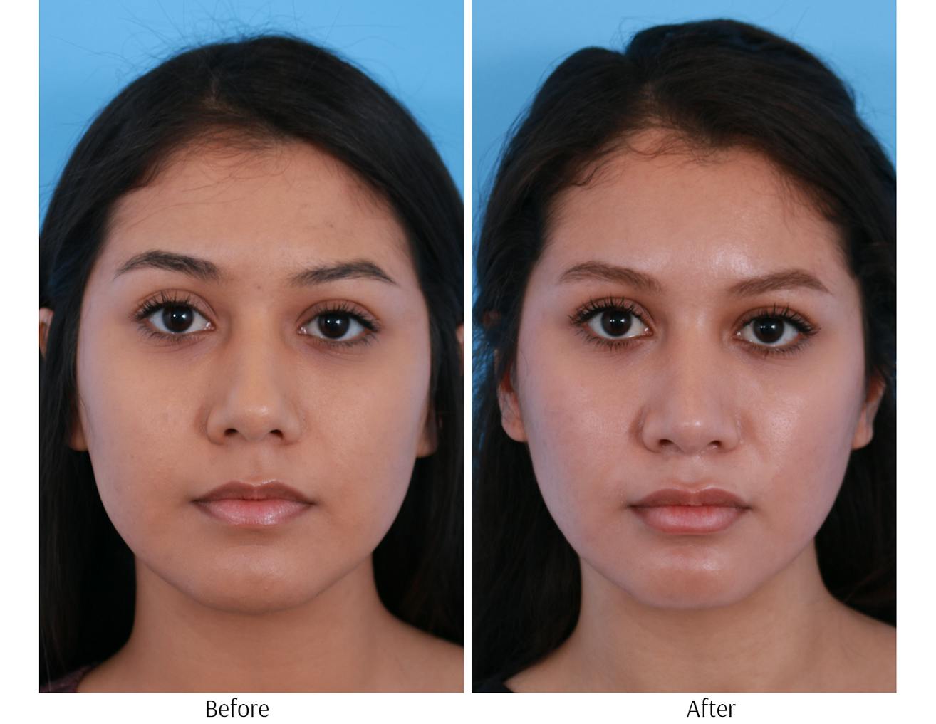 Rhinoplasty Before & After Gallery - Patient 64080950 - Image 4