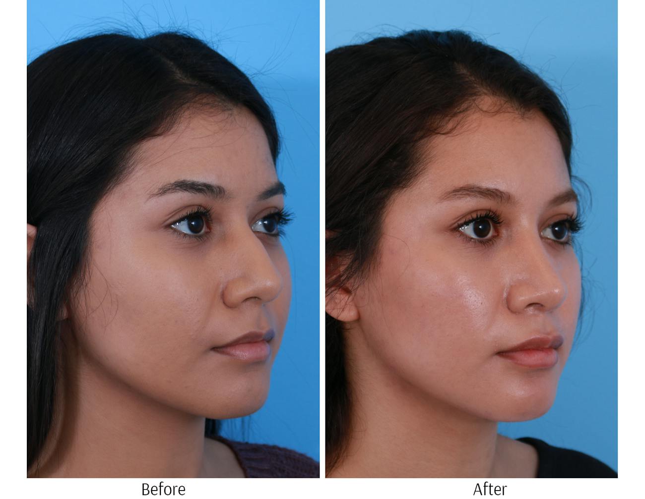 Rhinoplasty Before & After Gallery - Patient 64080950 - Image 5